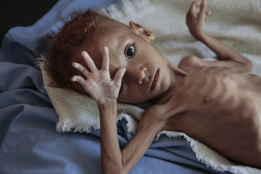 متى ستعلنون حالة الطوارئ؟!!.. مصادر طبية: ألفا يمني ماتوا بالملاريا خلال شهرين