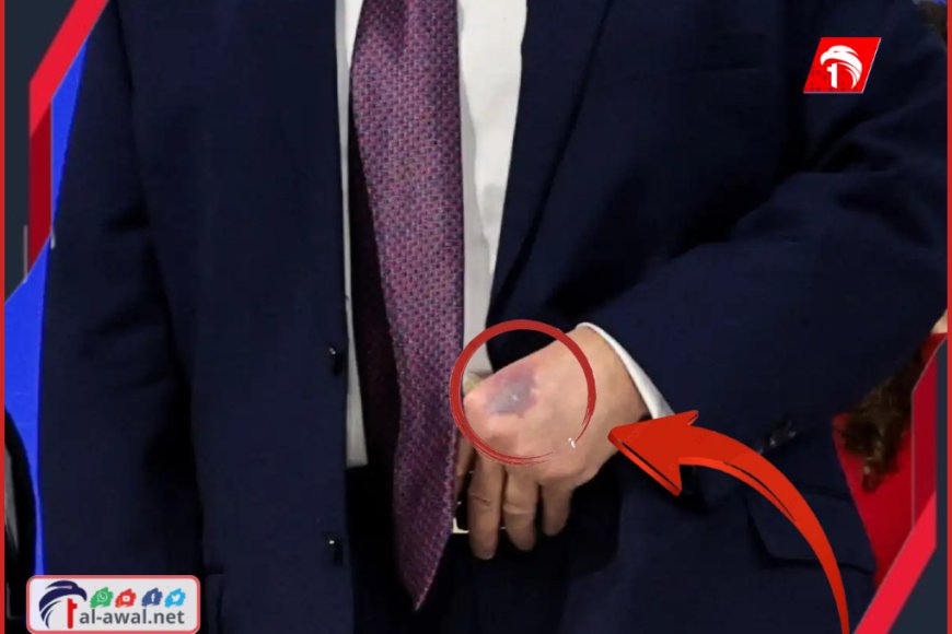 غريب وصادم حدوثها لرئيس أمريكا.. ترامب يكشف سر (أحدث كدمة) على يده غريب وصادم حدوثها لرئيس أمريكا.. ترامب يكشف سر (أحدث كدمة) على يده