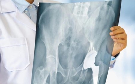 مواد غذائية تزيد من خطر الإصابة بهشاشة العظام