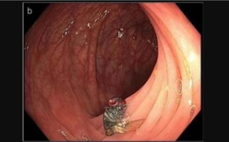 العثور على ذبابة حية داخل قولون رجل بريطاني.. هل لها تفسير طبي؟