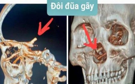 عانى من الصداع.. رجل يكتشف إصابته بـأمر غير متوقع في رأسه