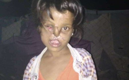 من يعيد لها البسمة.. طفلة مشوهة الوجه بحاجة لعملية تجميلية