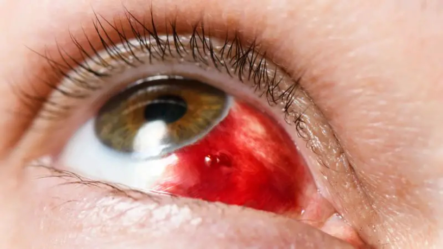 أسباب انفجار الأوعية الدموية في العين