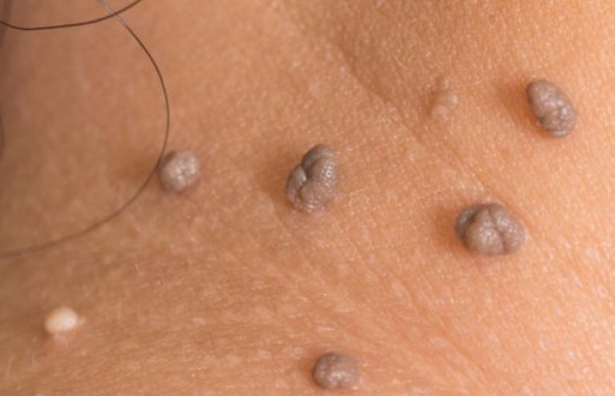 ما هي الزوائد الجلدية وهل لها علاقة بالسرطان؟