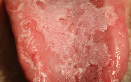 أخطر أمراض اللسان.. أسبابه لن تخطر على بالك