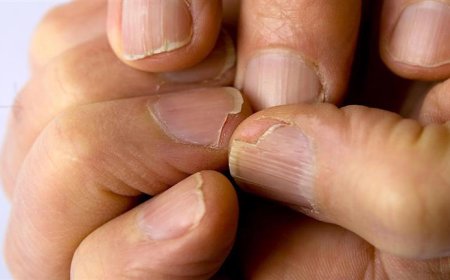 "تظهر على أظافرك".. 3 علامات تشير إلى نقص الحديد