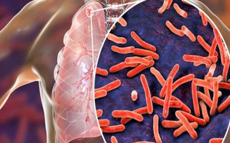 «ينتشر مثل البرد».. مرض السل شديد العدوى وطرق الوقاية منه