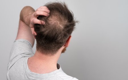 طبيب يكشف عن 5 أطعمة تحارب الصلع وتعزز نمو الشعر