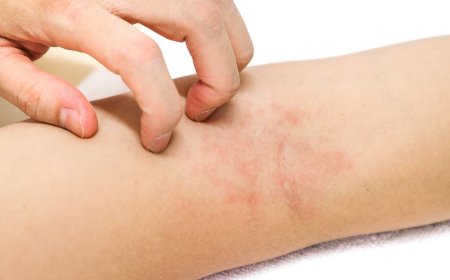 أكزيما خلل التعرق".. مصدر قلق في فصل الصيف