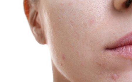 أسباب ظهور الحبوب على حسب مكانها في الوجه