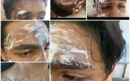 إصابة خمسة طلاب بجروح إثر اشتعال النيران في معمل تطبيقي بجامعة تعز