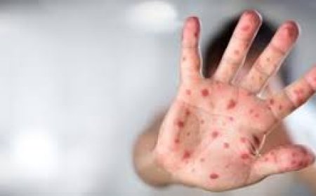 السويد ترصد أول إصابة بـ"جدري القردة"