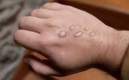 جدري القرود في إفريقيا.. الإصابات بالالاف..