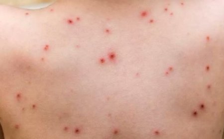 دولة عربية تسجل ظهور حالة إصابة بفيروس جدري القرود