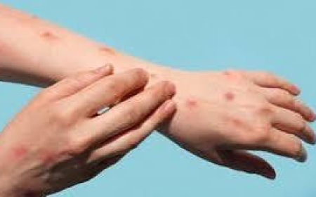 الإعلان عن أول لقاح ضد جدري القردة