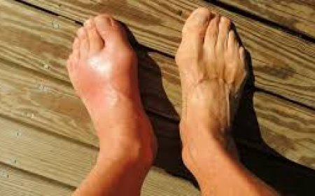 كيف تقلل من مستوى حمض اليوريك في جسدك؟