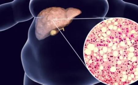 أخطر من الكحول .. الكشف عن (عنصر غذائي) يسبب تراكم الدهون على الكبد