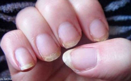 علامات على الاظافر تخبرك بارتفاع الكولسترول في الدم .. تعرف عليها