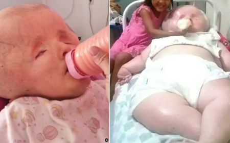 الرأس العملاق مرض أصاب طفلة .. فأصبح تحدي للام .. ما القصة