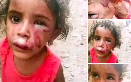 أم تعذب ابنتها بطريقة وحشية في تعز ...  والسبب لا يصدق