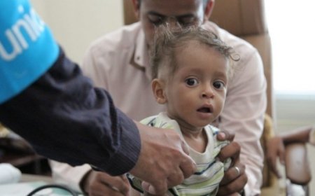 اليمن تسجّل أعلى معدلات سوء التغذية في العالم
