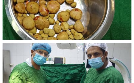 في عملية مُعقدة.. استخراج 61 حصوة من مريض في مستشفى بشبوة 