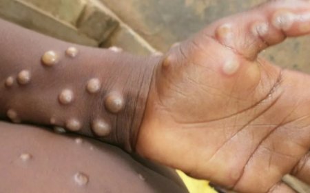 تسجيل أول حالة بمرض جدري القرود في محافظة يمنية