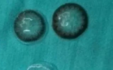 اكتشاف خمس عدسات خلف مقلة العين لإمرأة صينية !  ..   تفاصيل