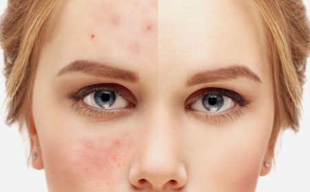 تعاني من البقع  الداكنة .. إليكِ هذه الوصفات الطبيعية للتخلص منها