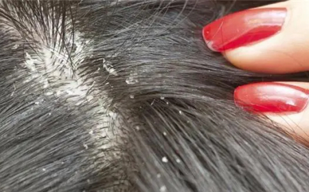 وصفات طبيعية للقضاء على قشرة الشعر نهائيًا