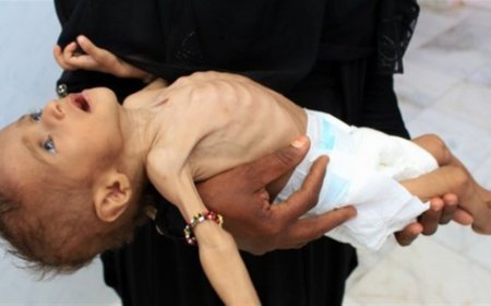 اليونيسف تطلق مبادرة تغذوية لتسريع الحد من نقص التغذية في اليمن