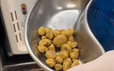 بسبب المشروبات الغازية.. ترسبت35 حصوة   كلوية ... تفاصيل