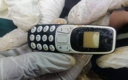 في بلد عربي ..استخرج هاتف من معدة شاب ابتلعه قبل عامين