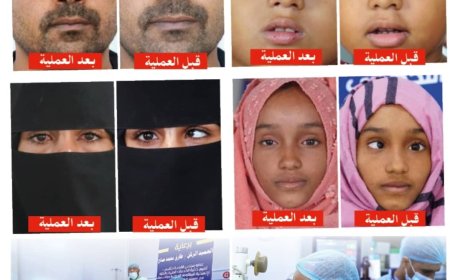 برعاية العميد طارق صالح..  غدًا انطلاق المخيم الطبي المجاني الثاني لجراحة حَوَل العين في المخاء
