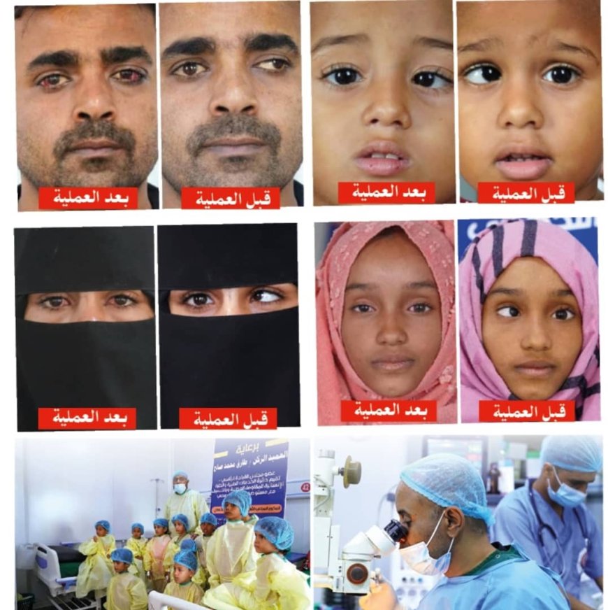 برعاية العميد طارق صالح.. غدًا انطلاق المخيم الطبي المجاني الثاني لجراحة حَوَل العين في المخاء