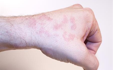 تعرف على الأعراض الأولية لسرطان الجلد ..