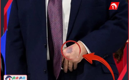 غريب وصادم حدوثها لرئيس أمريكا.. ترامب يكشف سر (أحدث كدمة) على يده