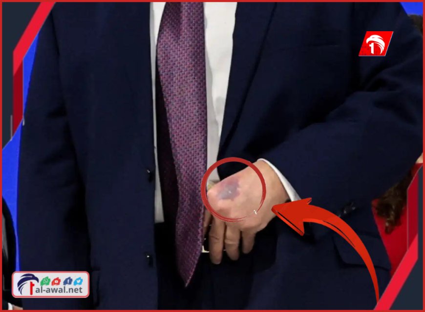 غريب وصادم حدوثها لرئيس أمريكا.. ترامب يكشف سر (أحدث كدمة) على يده