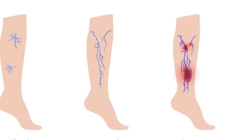 دوالي الساقين.. أسبابها و كيفية الوقاية منها