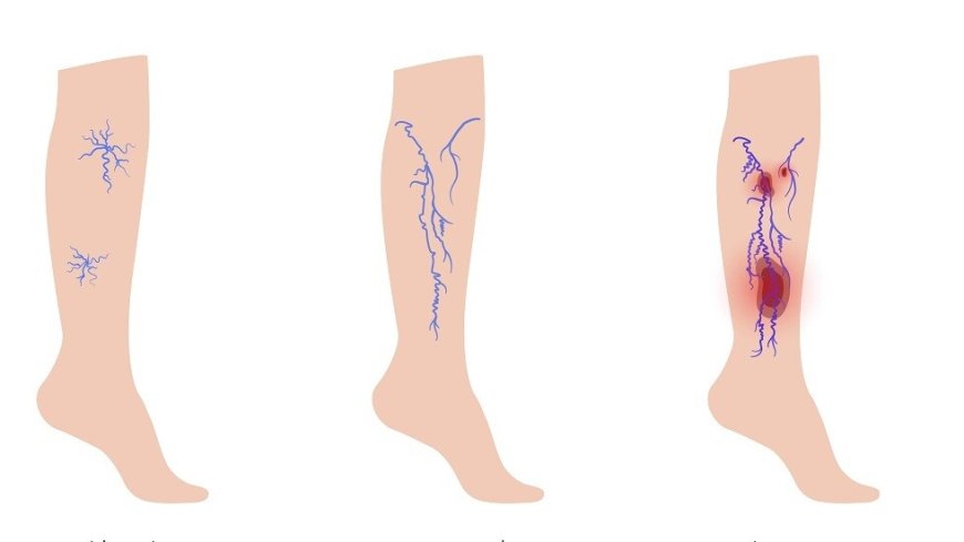 دوالي الساقين.. أسبابها و كيفية الوقاية منها