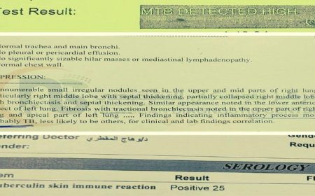 عاجل: طبيب يكشف فضيحة طبية :صنعاء.. تعالج السل الرئوي على أنه تيفود:  تحذير للمواطنين
