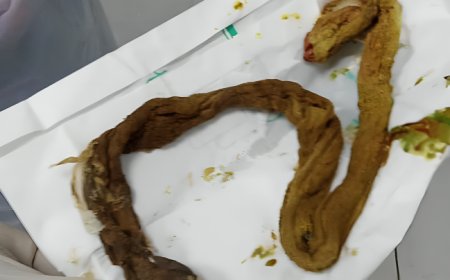 شاش داخل أحشاء امرأة بعد قيصرية في عدن  فضيحة إهمال طبي تهز الشارع