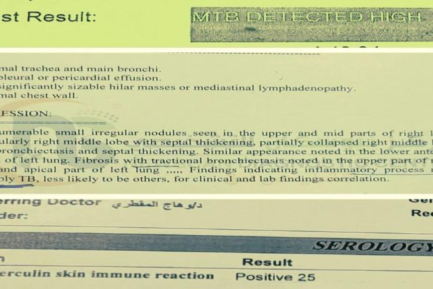 عاجل: طبيب يكشف فضيحة طبية :صنعاء.. تعالج السل الرئوي على أنه تيفود: تحذير للمواطنين