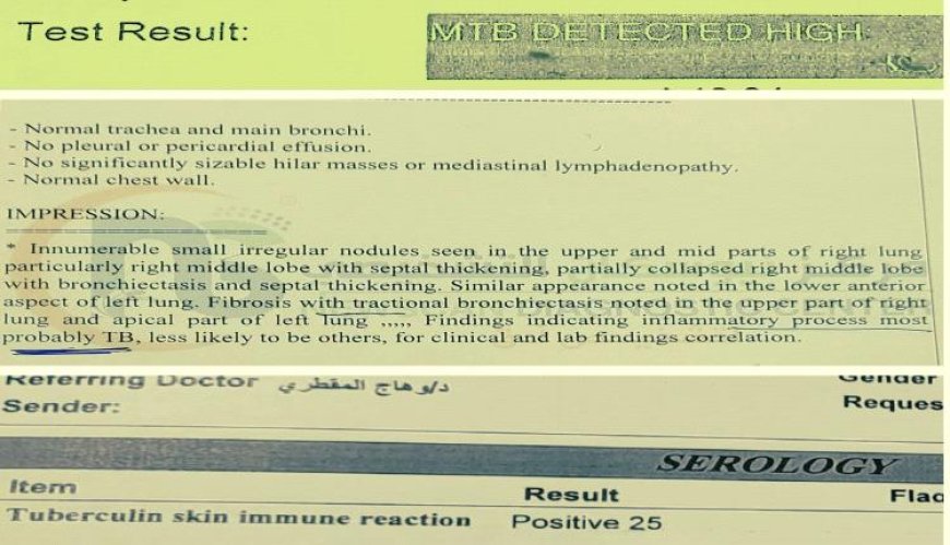 عاجل: طبيب يكشف فضيحة طبية :صنعاء.. تعالج السل الرئوي على أنه تيفود:  تحذير للمواطنين