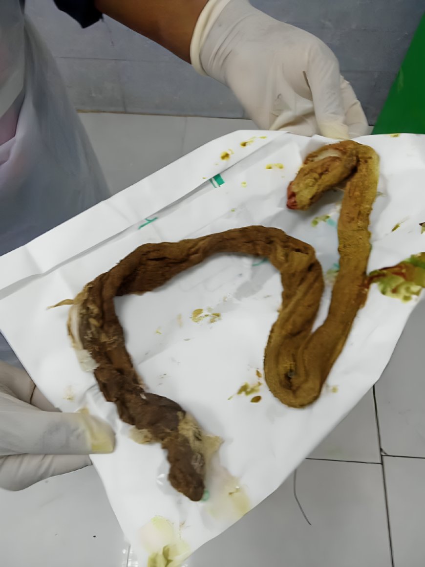 شاش داخل أحشاء امرأة بعد قيصرية في عدن  فضيحة إهمال طبي تهز الشارع