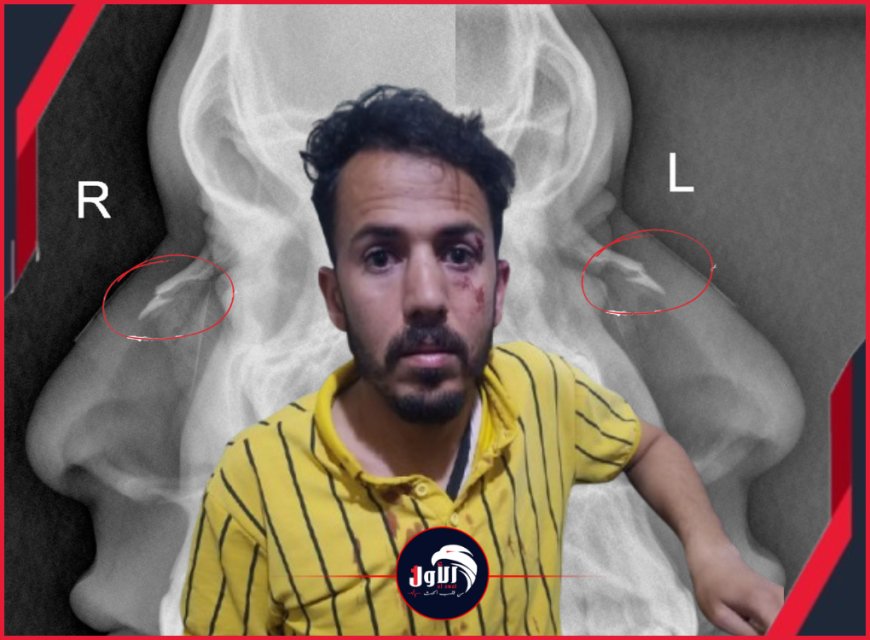 بالصور: بين كسر الأنف ونزيف العين.. تفاصيل الاعتداء الهمجي على (حكم) مباراة ديربي صنعاء!